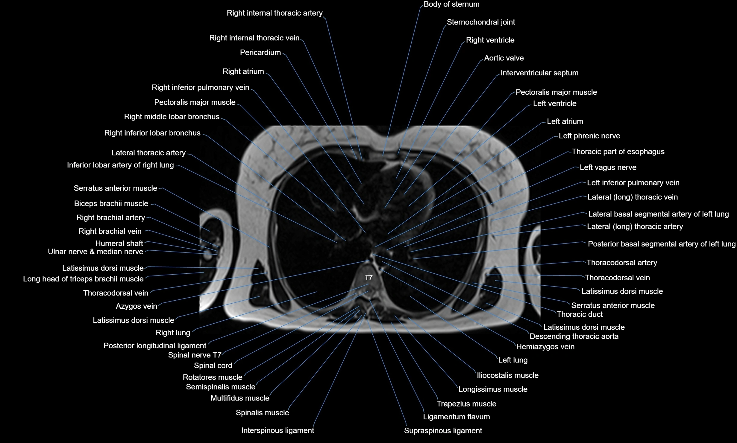 MRI chest axial  cross sectional anatomy 3T radiology  image-img-00001-00025.webp